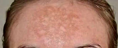 Cure therapies to treat melasma
